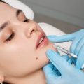 Dermal fillers in Surf City