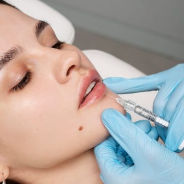 Dermal fillers in Surf City